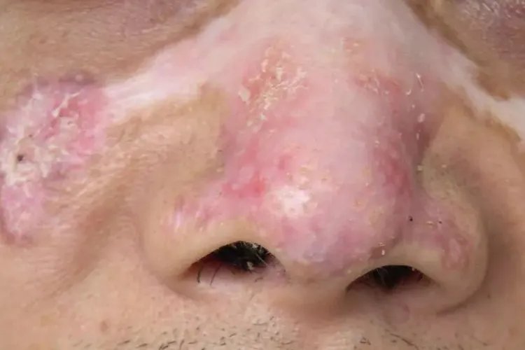 女性红斑狼疮早期症状图片