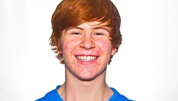 脸上红痘印怎么消除