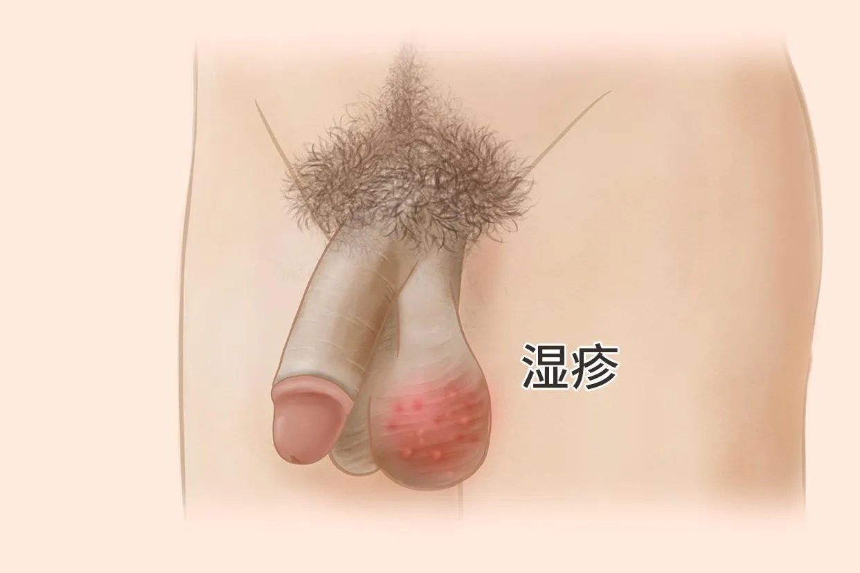 阴囊湿疹的症状和图片