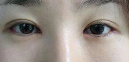 杭州一般做双眼皮多少钱