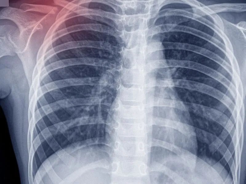 肺癌能吃西洋参吗