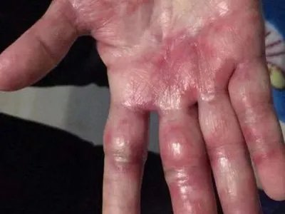 3级手足综合征症状图片