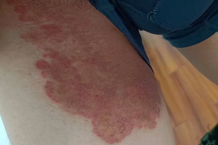 大腿内侧湿疹和股癣图片