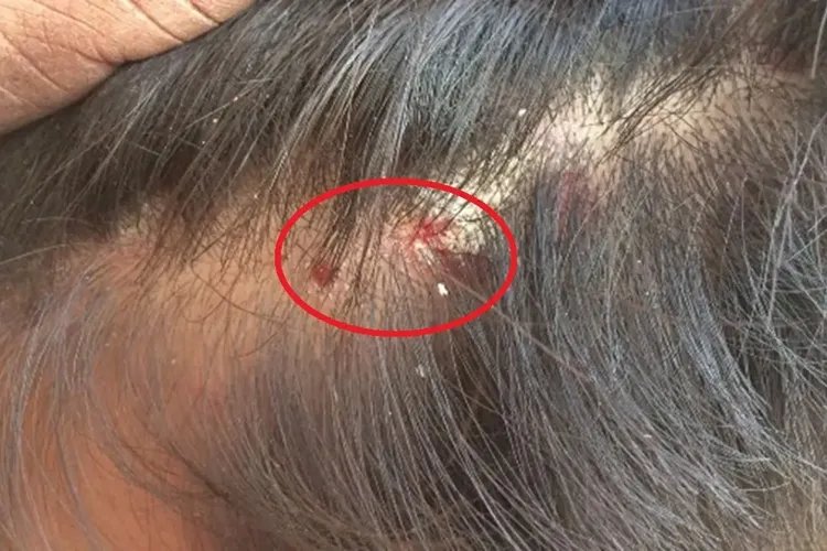 寄生虫性皮肤病图片