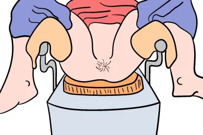 小孩痔疮初期图片