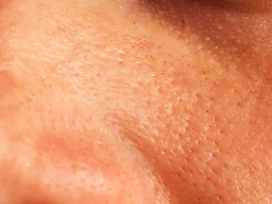 如何去除去黑头