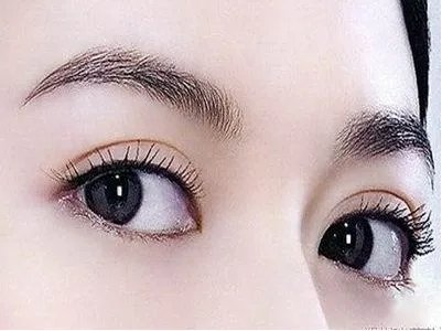 开内眼角手术大约要多少钱