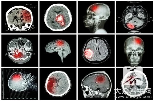 脑干梗塞的典型症状