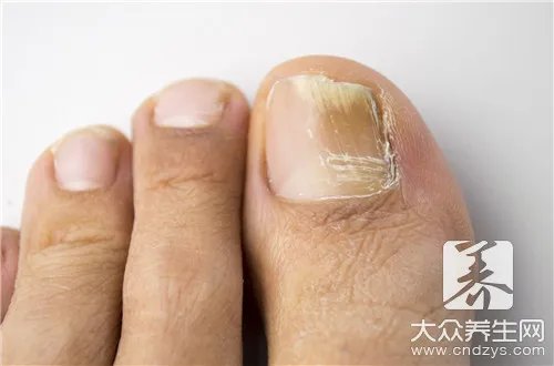 孩子脚指甲凹陷