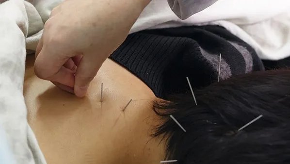 针灸减肥效果好吗