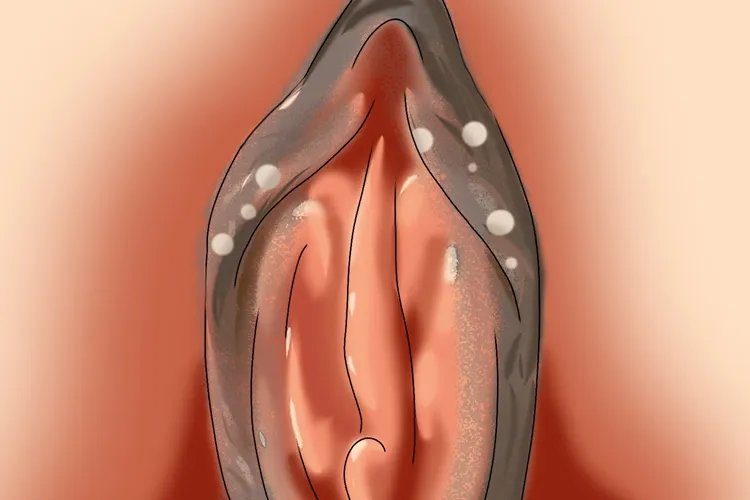 外阴白色病变的图片