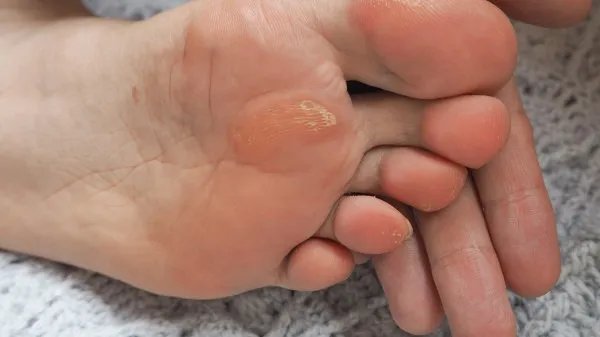 脚气不等于脚气病,别再分不清楚