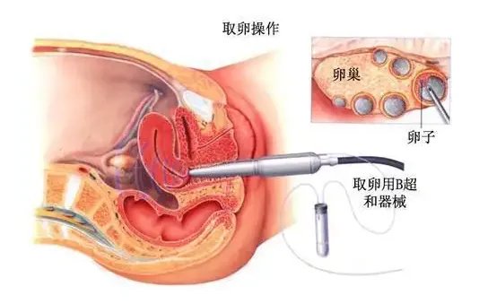 杭州供卵捐卵试管男宝-在杭州生男孩要多少钱？