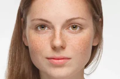 激素斑怎样去除