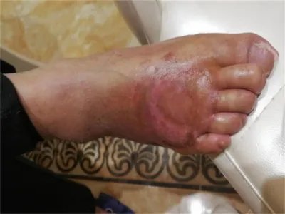 3级手足综合征症状图片