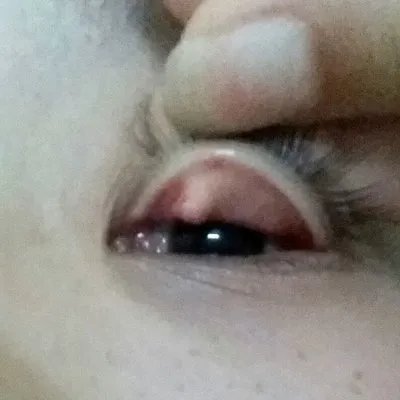 甲亢症状有哪些?