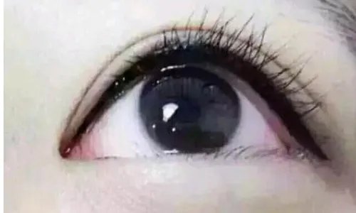 开眼角疤痕增生了怎么办