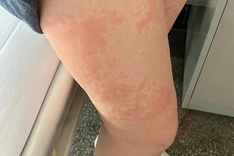 寄生虫性皮肤病图片