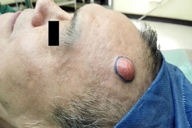 头部皮脂腺囊肿图片