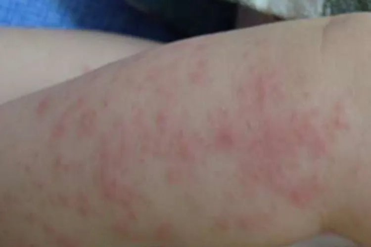 儿童腿上长湿疹的症状和图片