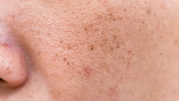 祛斑最好的方法