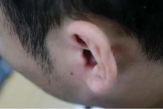 耳朵后面神经痛怎么办