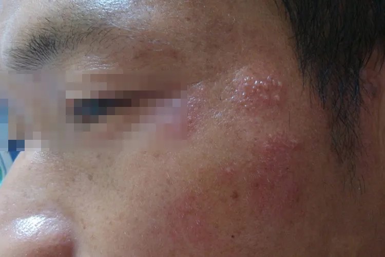 轻度带状疱疹图片