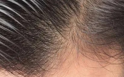 自体毛发移植的好处