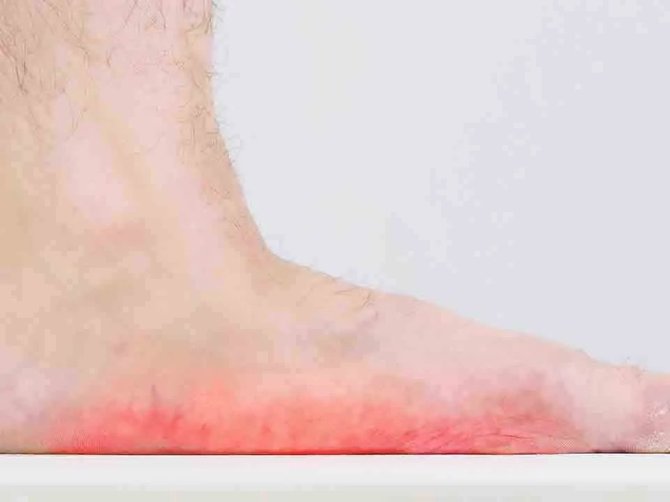 灰指甲原因有哪些