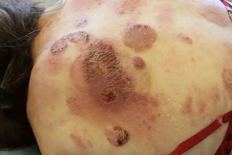 白血病早期红疹图片