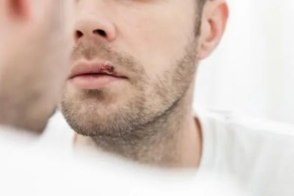 怎么预防口角生疮 预防口角生疮的三技巧分享