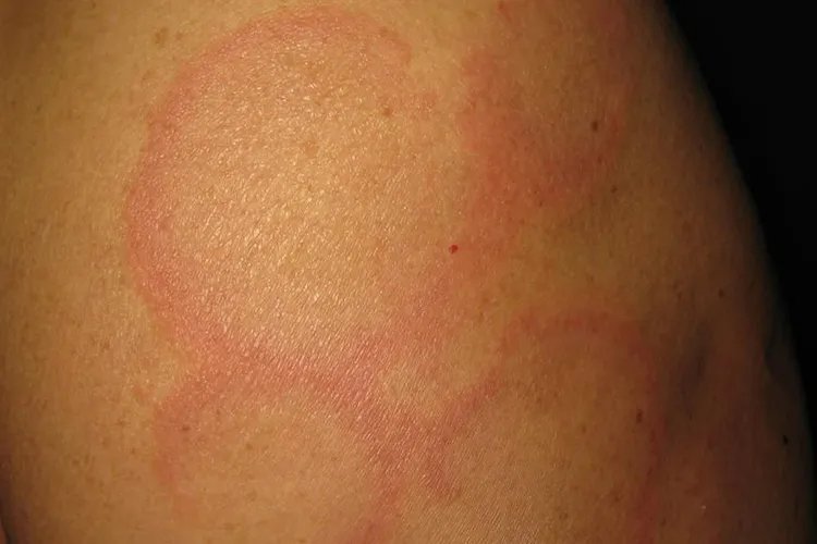 女性红斑狼疮早期症状图片