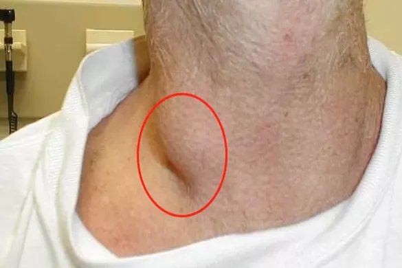 右锁骨淋巴结肿大图片