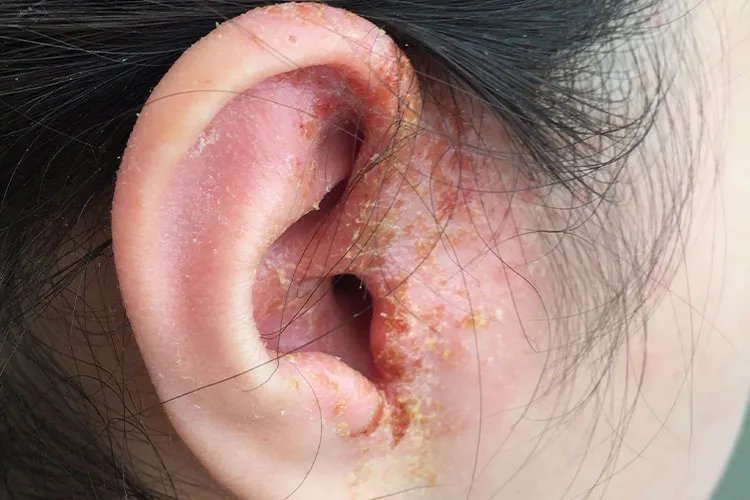 皮肤湿疹是什么样子的