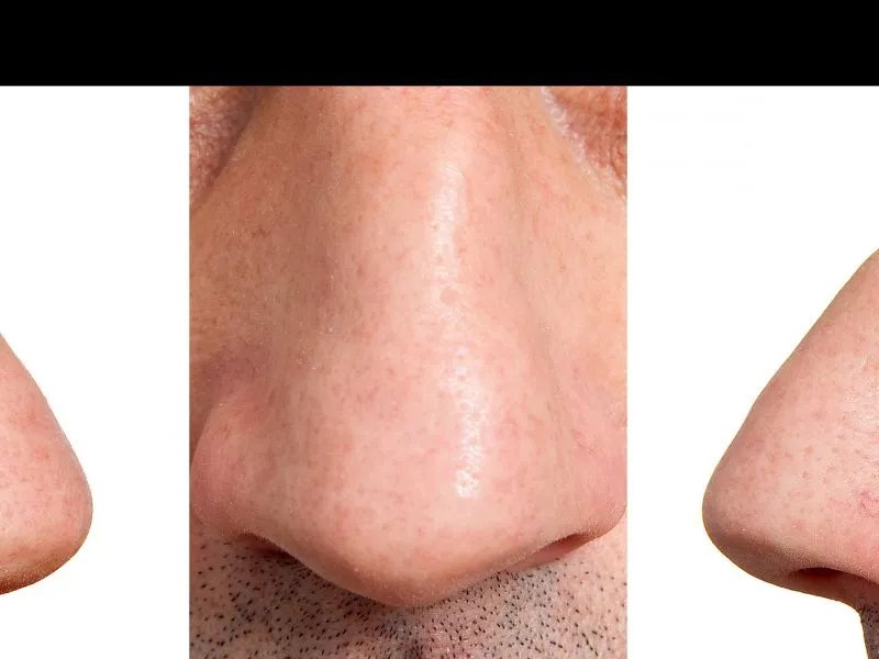 什么是鼻综合手术