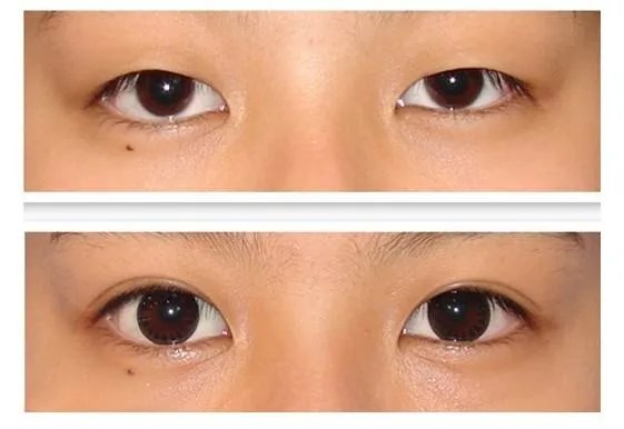 男士割双眼皮的标准