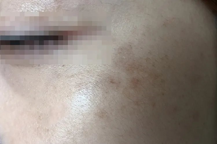 眼睛周围长黄褐斑图片