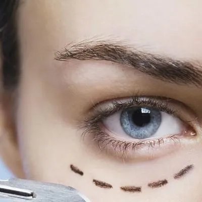 天生眼袋怎么去