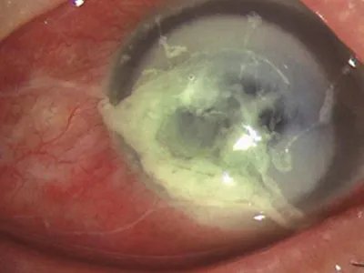 细菌性角膜炎症状图片