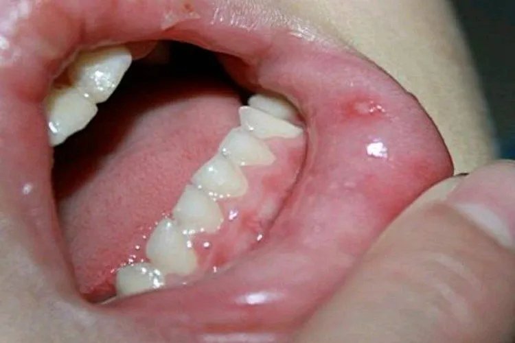 宝宝手足口病初期症状图片