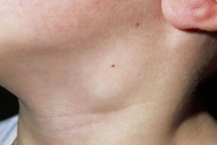 淋巴癌症状有哪些图片