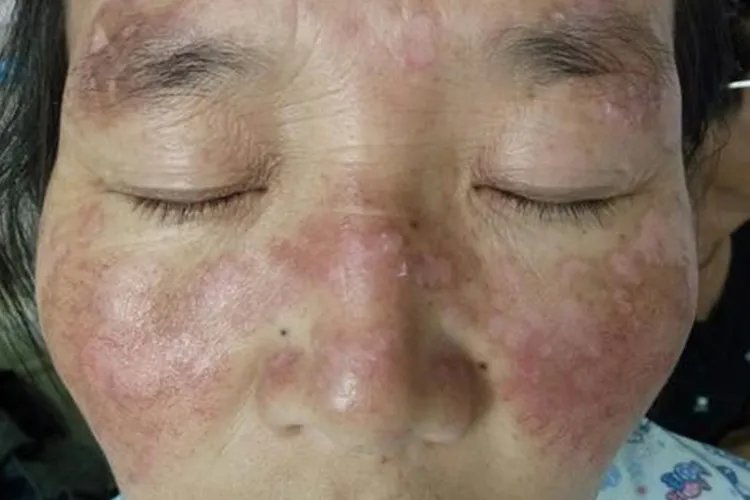 红斑狼疮脸上红斑图片