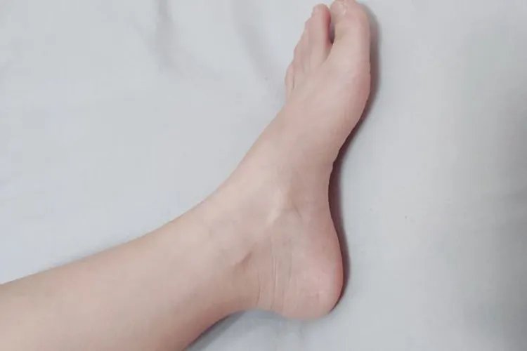 直脚板与正常脚区别图