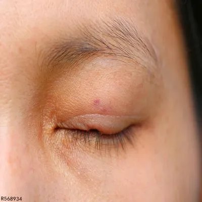 眼皮长了个小肉粒怎么办