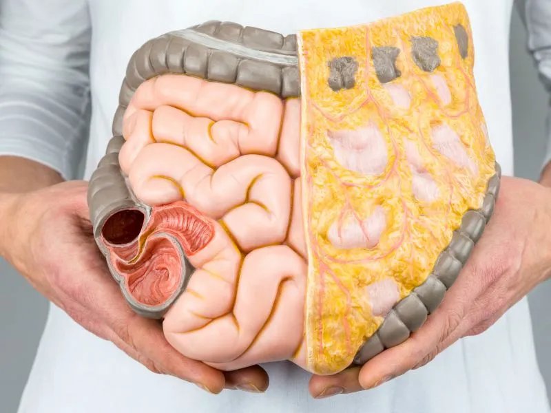 结肠冗长症的症状及治疗