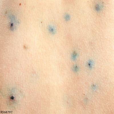 身上皮肤青紫是什么原因