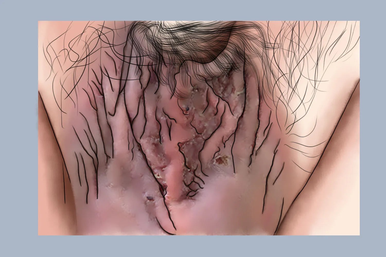 阴囊湿疹的症状图片