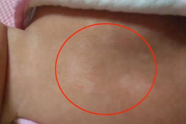 白癜风最初症状图片