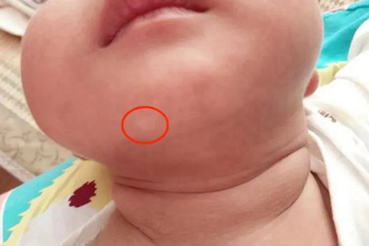 白癜风最初症状图片