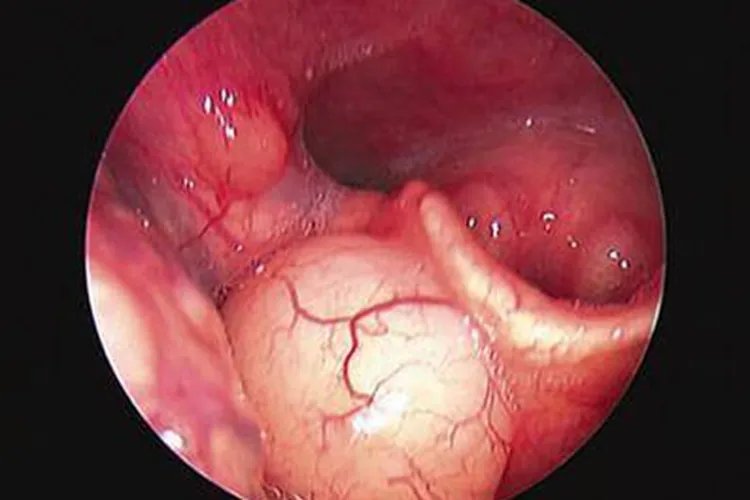 甲醛会导致身体出现哪些状况图片
